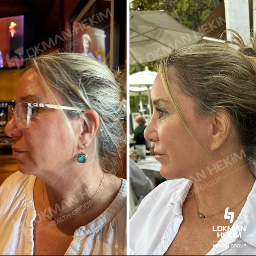 Jawline contouring Photo avant/après